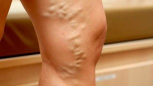 varicose veins in women