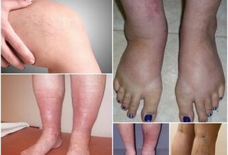 Pictures of manifestations of varicose veins on the legs