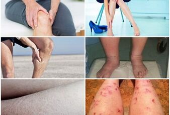 Symptoms of varicose veins of the legs
