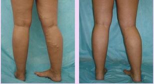how varicose veins manifest from the first stage