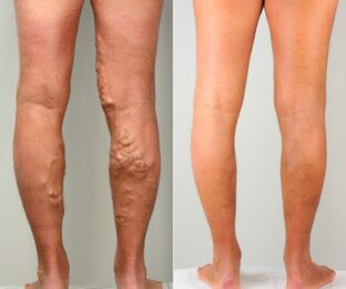 Stages of varicose veins of the legs