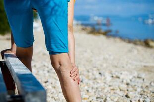 Varicose veins of the lower extremities from exercise