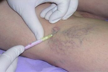 sclerotherapy as a method of treating varicose veins