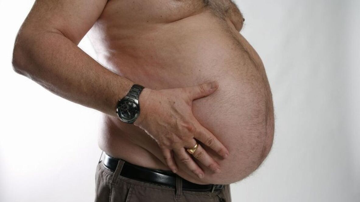 obesity as a cause of varicose veins