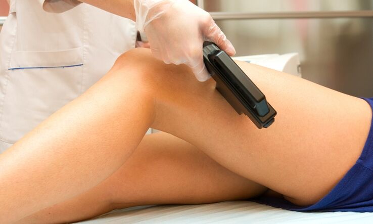 laser procedure for the treatment of varicose veins