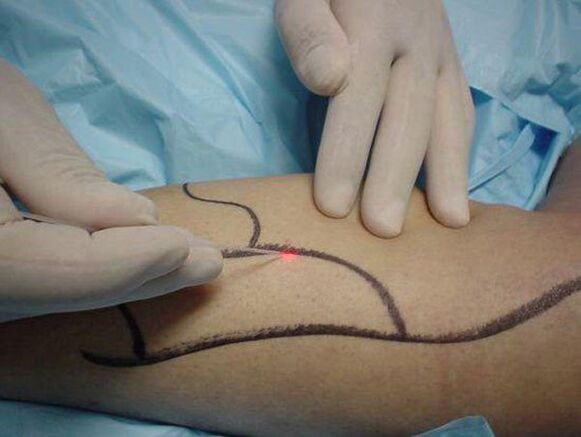laser treatment of varicose veins
