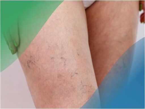 The vascular network of the legs is one of the symptoms of varicose veins