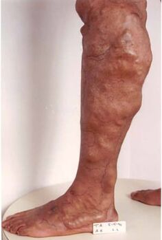 Manifestations of chronic venous insufficiency in the lower limb