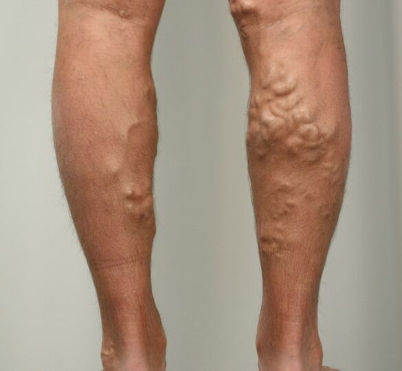 Varicose veins of the legs