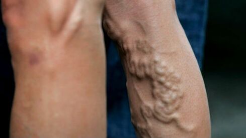 Manifestations of advanced varicose veins of the lower extremities