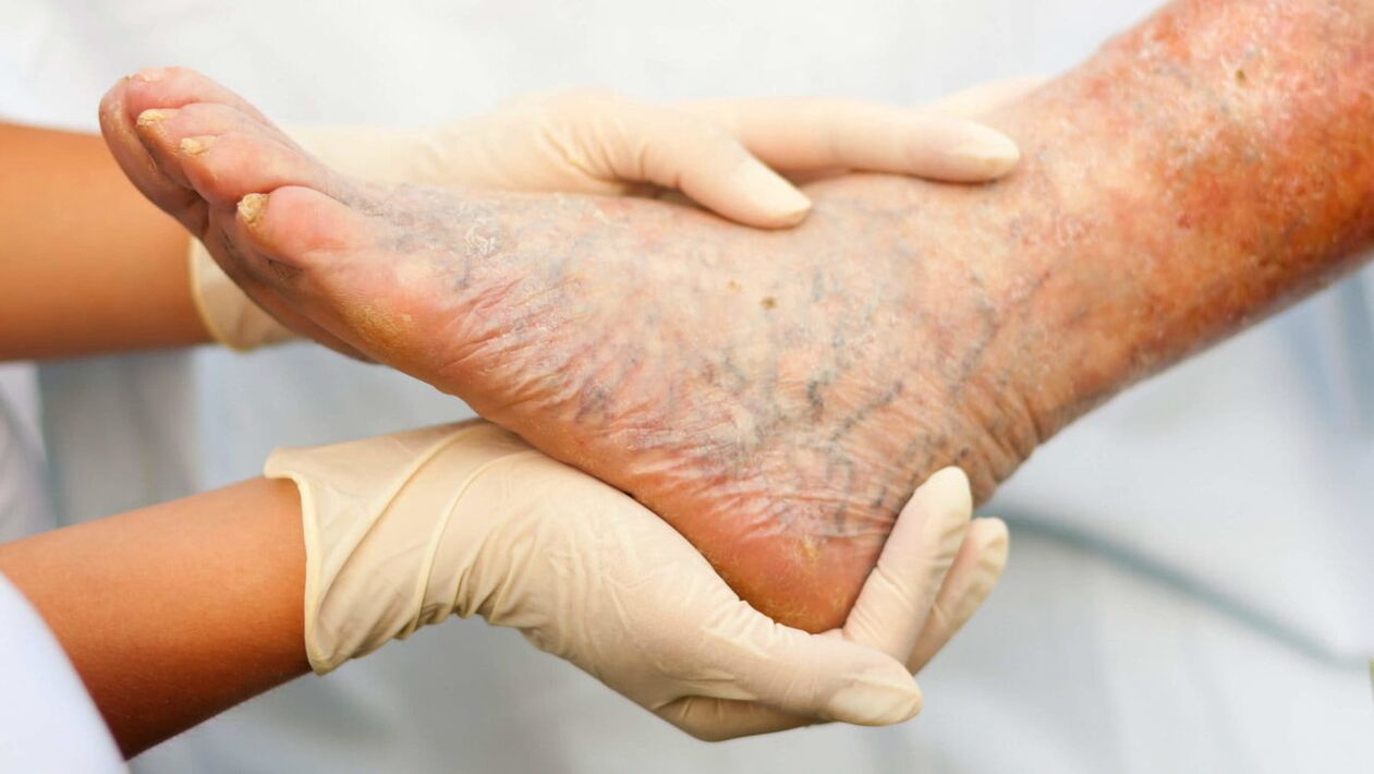 The phlebologist deals with the treatment of varicose veins of the legs