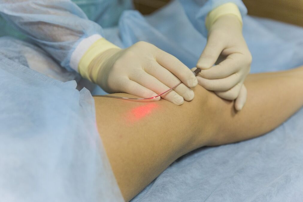 Laser treatment of varicose veins of the lower limbs