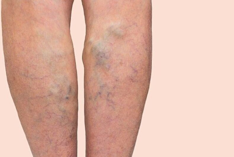 signs of varicose veins