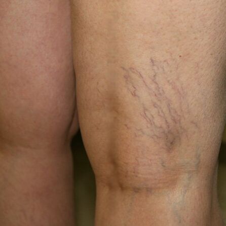 A venous network of the lower extremities is a sign of varicose veins