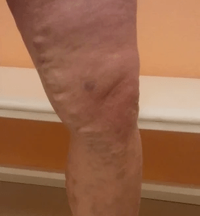 Different veins