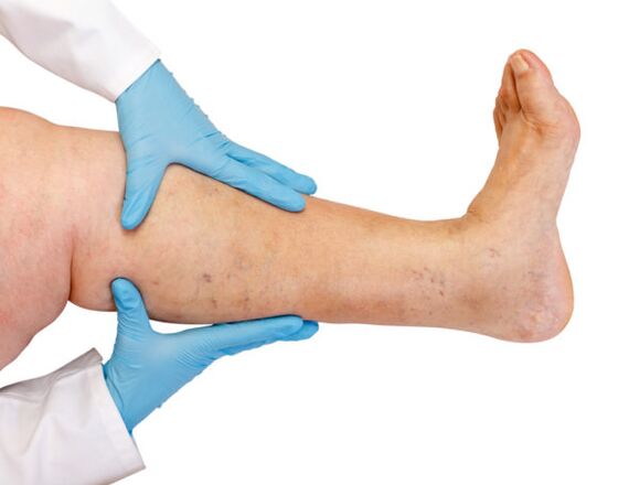 Varicose veins