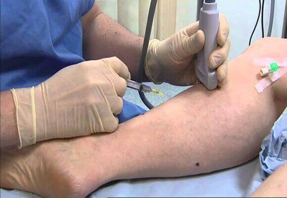 Varicose veins