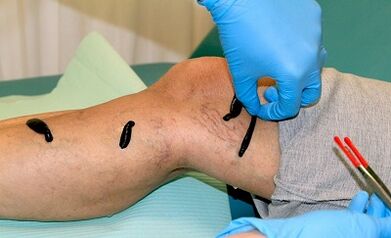 Varicose therapy for varicose veins