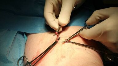 Flbectomy for varicose veins