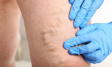 Varicose veins