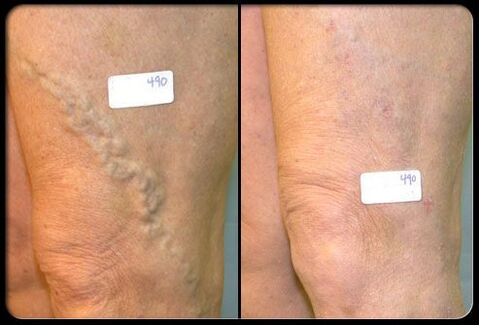Before and after surgery in the veins