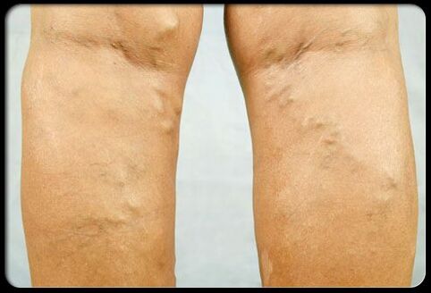 Varicose veins