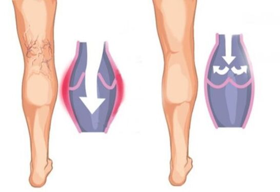 What varicose veins seem