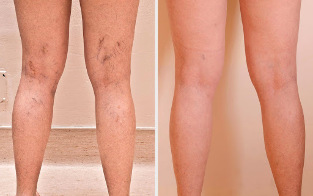 Pre-and post-sclerotherapy